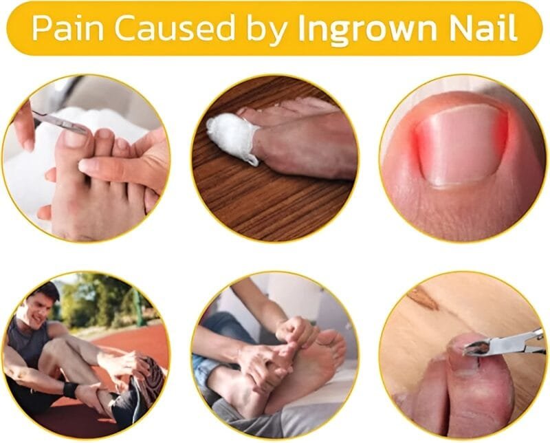 30 Pcs - Glue Free Ingrow Toenail Corrector Stickers | Ingrown Toe Nail Pain Reliever Patches - Image 13