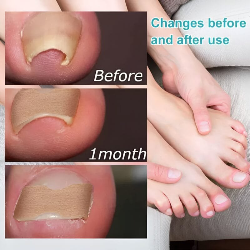 30 Pcs - Glue Free Ingrow Toenail Corrector Stickers | Ingrown Toe Nail Pain Reliever Patches - Image 7