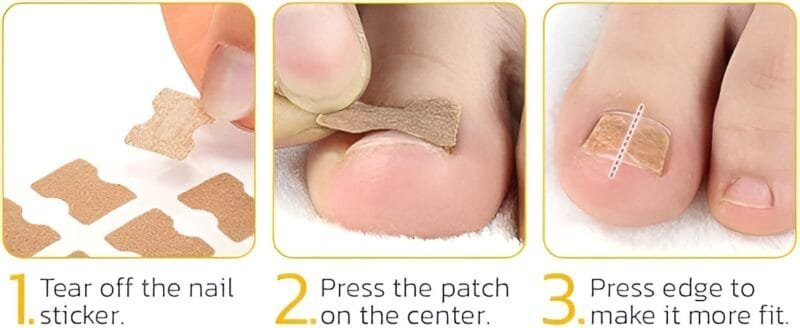 30 Pcs - Glue Free Ingrow Toenail Corrector Stickers | Ingrown Toe Nail Pain Reliever Patches - Image 12