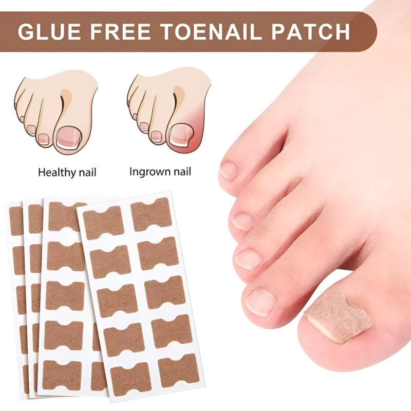 30 Pcs - Glue Free Ingrow Toenail Corrector Stickers | Ingrown Toe Nail Pain Reliever Patches - Image 4